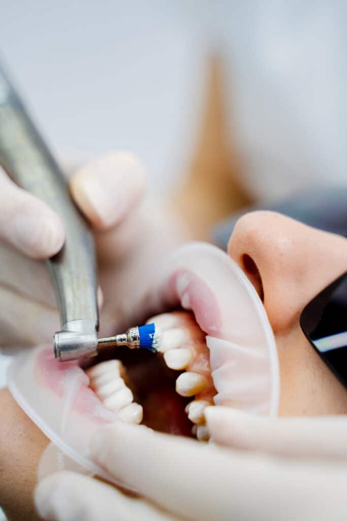 Dentist removing plaque and surface stains