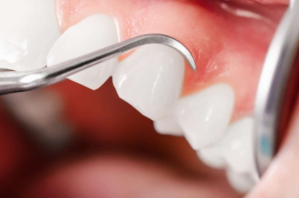 Dentist performing periodontal maintenance on a patient