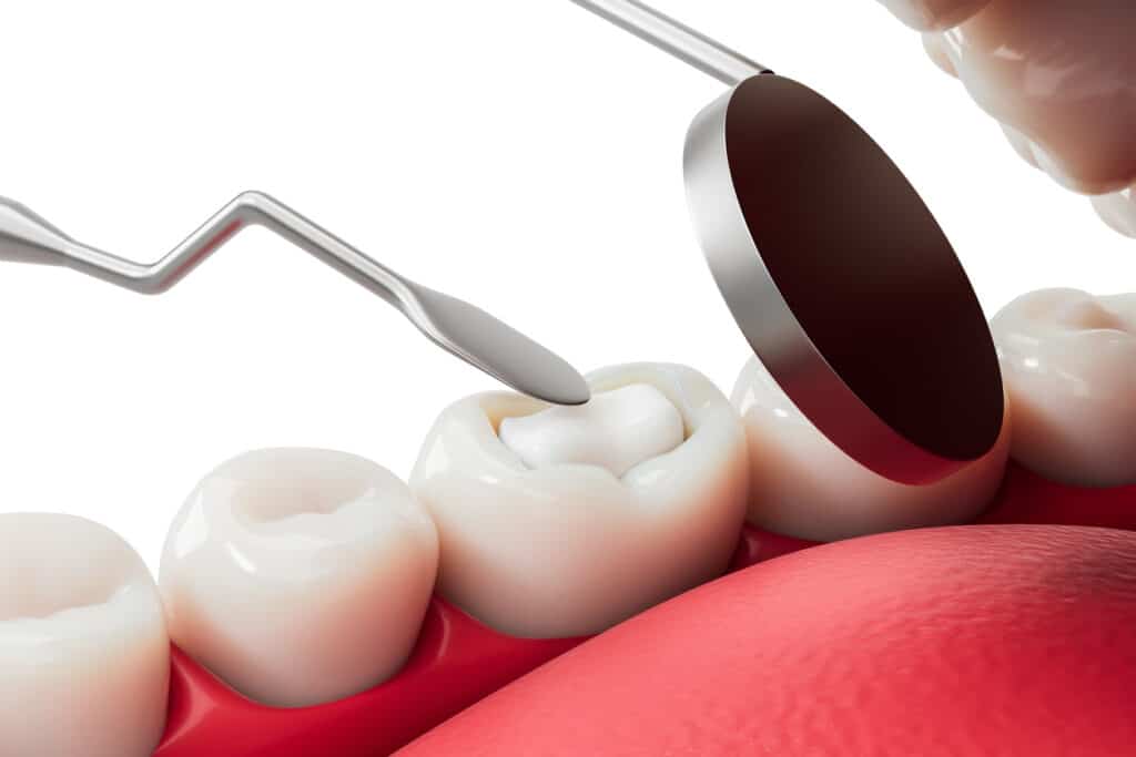 Showing a cavity being placed onto a molar