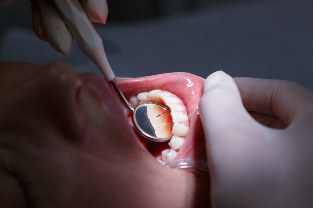 Dental patient with a dental filling for a chipped tooth