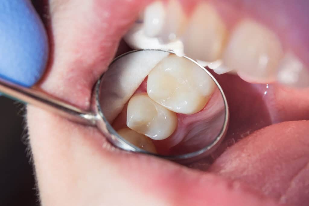 Dentist showing a patient's dental filling with a dental mirror
