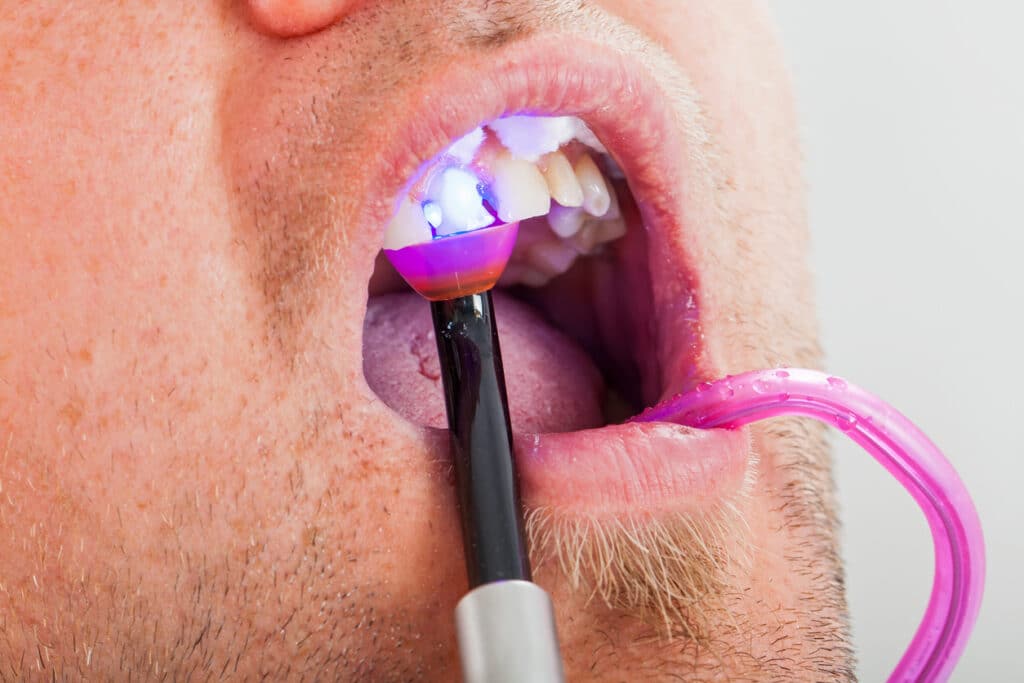 dental patient receiving a dental filling